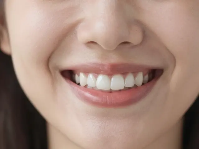 Celokeramické fazety: Jak získat úsměv, který si zasloužíte